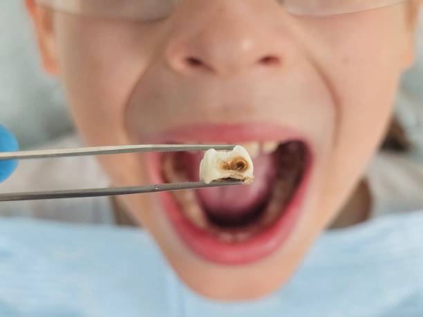 Best Urgent Care for Lost Fillings or Crowns in Cooper City, FL